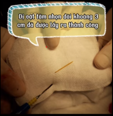 Tăm nhọt đâm bé 6 tuổi thủng ruột, viêm phúc mạc