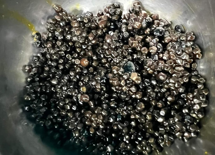 Bác sĩ ngỡ ngàng với hàng nghìn viên sỏi trong túi mật bệnh nhân