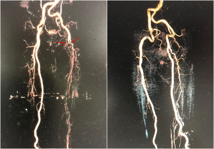 Hình ảnh động mạch đùi trái của bệnh nhân bị tắc nghẽn do huyết khối được tái thông sau phẫu thuật lấy huyết khối.
