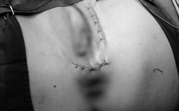 Bệnh nhân được phẫu thuật chuyển vạt vá lỗ rò trực tràng âm đạo