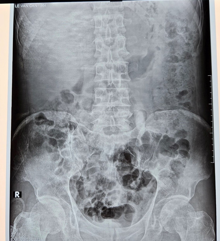 Sỏi niệu quản trên phim chụp