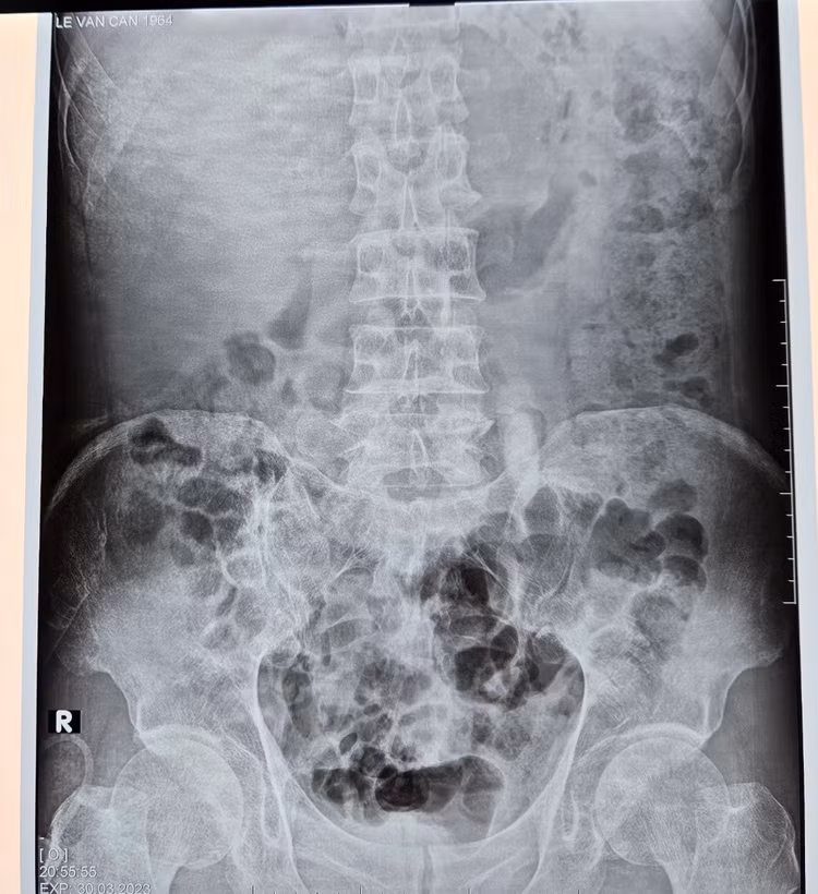 Sỏi niệu quản trên phim chụp