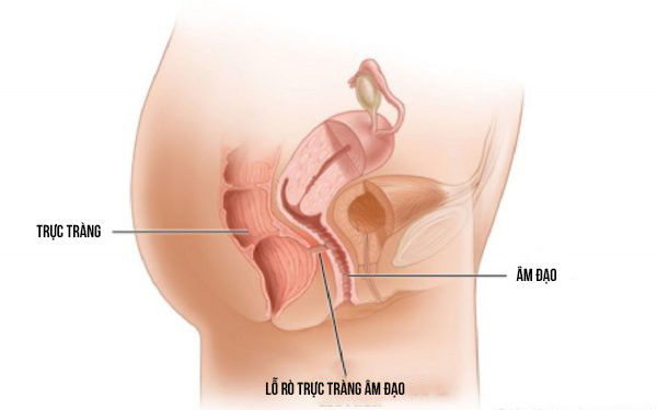 Hình minh họa lỗ rò trực tràng âm đạo