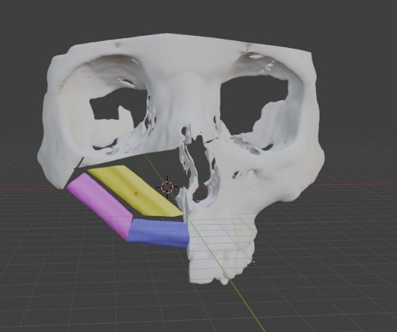 Bệnh nhân D. 29 tuổi. Mất đoạn xương hàm dưới được phẫu thuật tạo hình bằng vạt xương vi phẫu được hỗ trợ công nghệ in 3D Bệnh nhân D. 29 tuổi. Mất đoạn xương hàm dưới được phẫu thuật tạo hình bằng vạt xương vi phẫu được hỗ trợ công nghệ in 3D