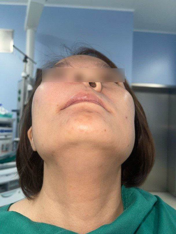 Bệnh nhân V. 30 tuổi, bệnh lý u nguyên bào tạo men xương hàm trên gây phá huỷ xương hàm trên bên phải - Ảnh BVCC Bệnh nhân V. 30 tuổi, bệnh lý u nguyên bào tạo men xương hàm trên gây phá huỷ xương hàm trên bên phải - Ảnh BVCC