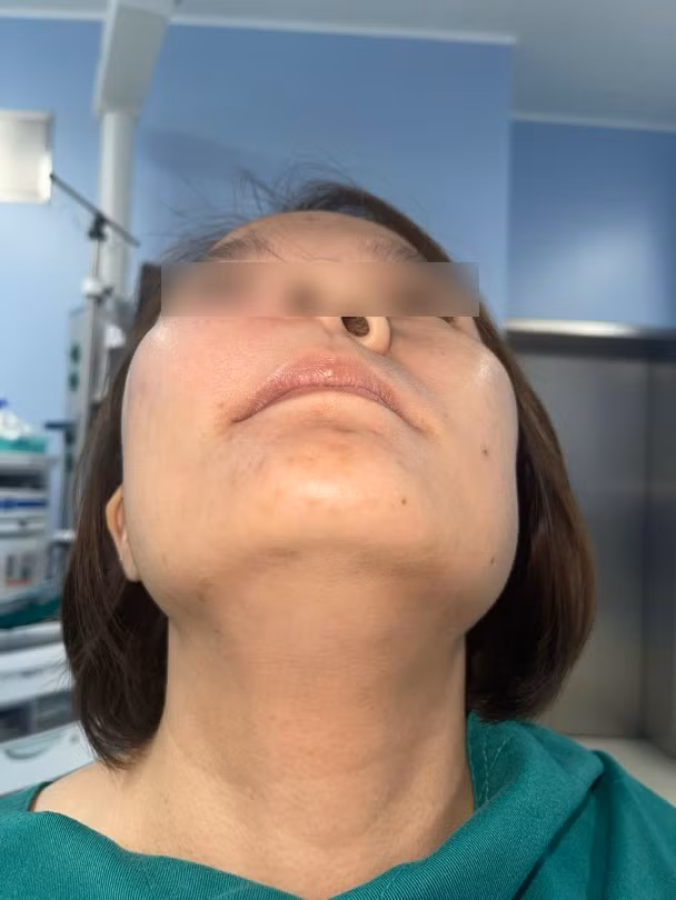 Bệnh nhân V. 30 tuổi, bệnh lý u nguyên bào tạo men xương hàm trên gây phá huỷ xương hàm trên bên phải - Ảnh BVCC