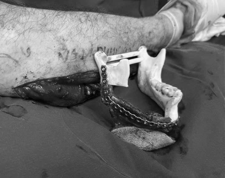 Công nghệ in 3D điều trị ung thư xương hàm mặt ảnh 3 Công nghệ in 3D điều trị ung thư xương hàm mặt ảnh 3