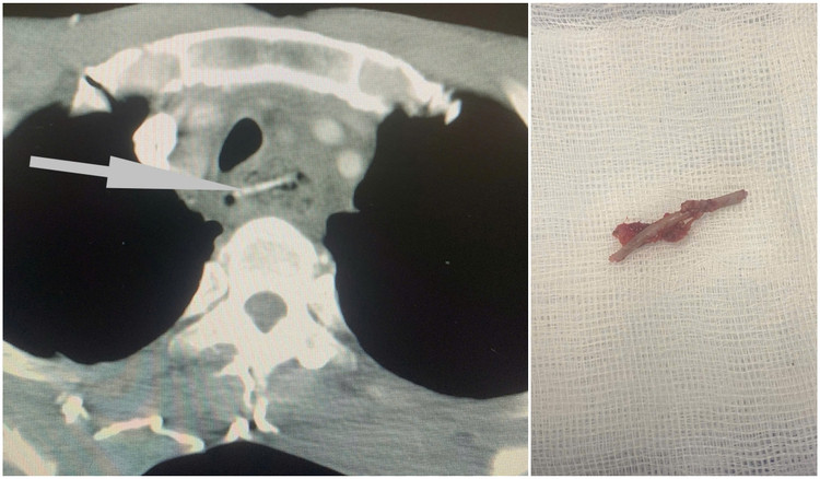 Dị vật thực quản bệnh nhân H. gây áp xe thực quản - Ảnh BVCC