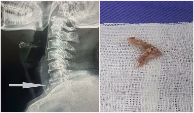 Hình ảnh bệnh nhân M. bị hóc xương gà vùng thực quản cổ được bác sĩ nội soi lấy ra an toàn - Ảnh BVCC