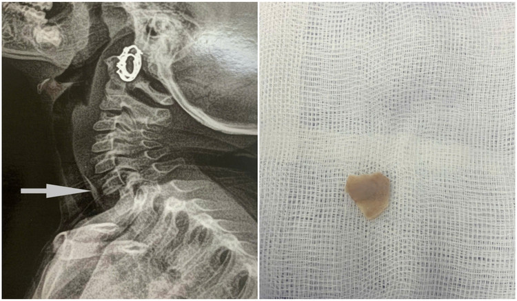 Hình ảnh bệnh nhi 3 tuổi bị hóc xương vùng thực quản cổ - Ảnh BVCC