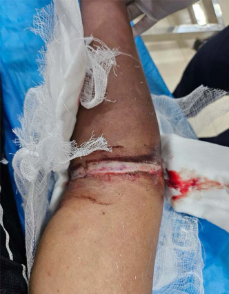 Tình trạng cánh tay của bệnh nhân thời điểm đến Bệnh viện Bãi Cháy - Ảnh BVCC