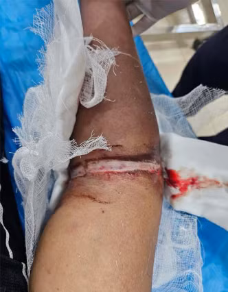 Tình trạng cánh tay của bệnh nhân thời điểm đến Bệnh viện Bãi Cháy - Ảnh BVCC Tình trạng cánh tay của bệnh nhân thời điểm đến Bệnh viện Bãi Cháy - Ảnh BVCC