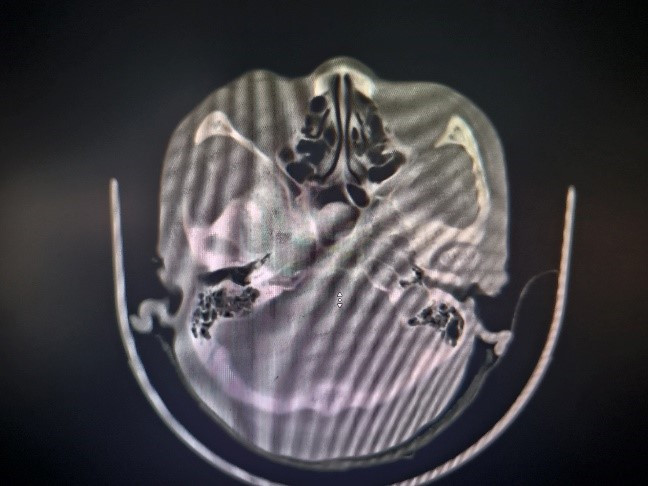 Hình ảnh nấm xâm lấn trong xoang bướm trên phim chụp