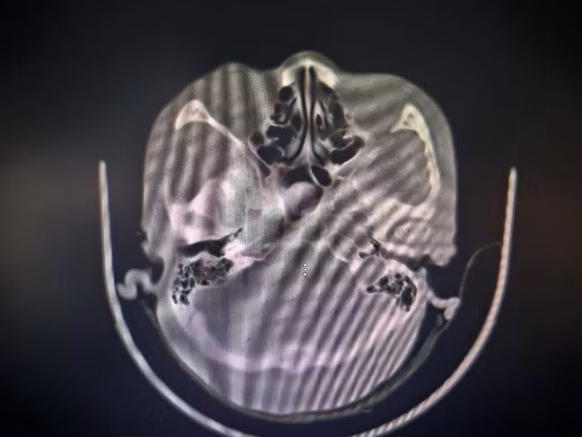 Hình ảnh nấm xâm lấn trong xoang bướm trên phim chụp