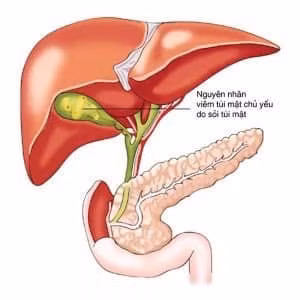 Bị sỏi túi mật không điều trị cụ bà 75 tuổi bị hội chứng Mirizzi