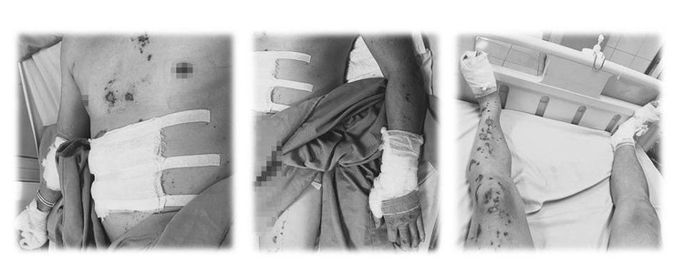 Tình trạng bỏng sâu đa vị trí trên cơ thể bệnh nhân sau khi bị điện giật