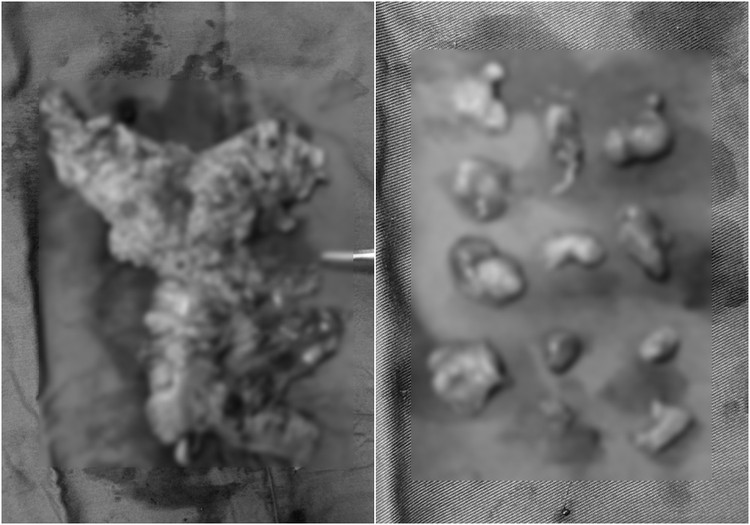 Đại tràng phải chứa khối ung thư và hạch được nội soi lấy ra thành công.