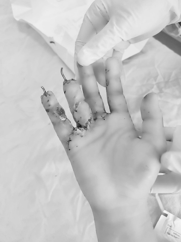 Bàn tay cháy đen vì nổ pháo tự chế