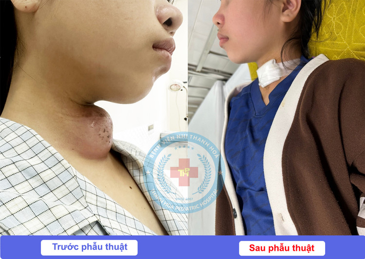 Lấy khối áp xe cổ 14 năm do dị tật khe hở mang cho trẻ ảnh 1
