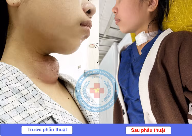 Lấy khối áp xe cổ 14 năm do dị tật khe hở mang cho trẻ ảnh 1
