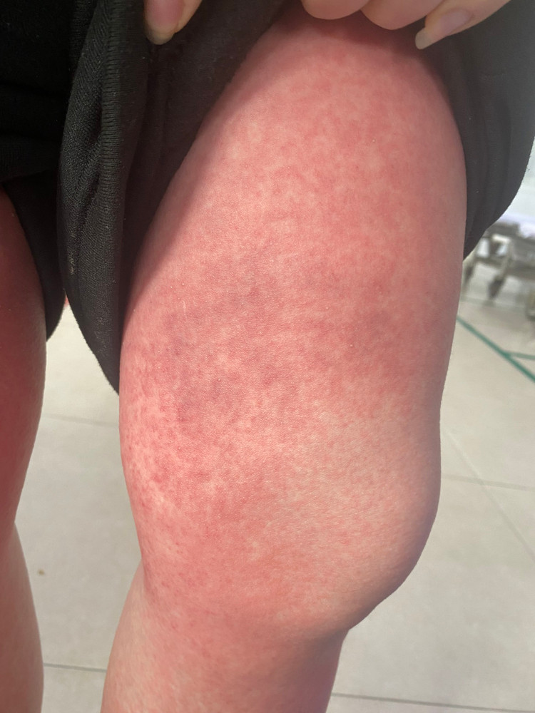 Sau 1 ngày uống thuốc viêm long đường hô hấp trẻ bị mụn mủ toàn thân