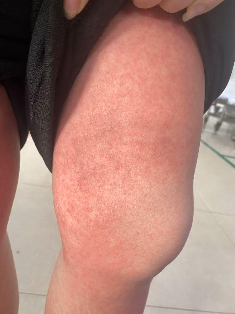 Sau 1 ngày uống thuốc viêm long đường hô hấp trẻ bị mụn mủ toàn thân