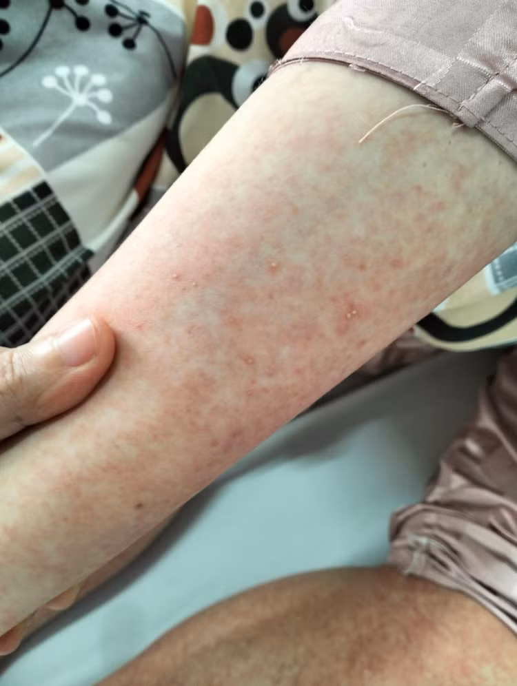 Tự mua thuốc chữa long đờm bé 13 tuổi bị nổi mụn mủ toàn thân