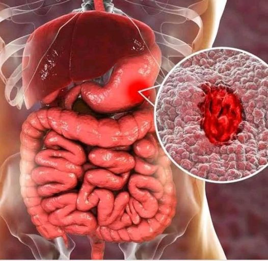 Bác sĩ mách dấu hiệu ung thư dạ dày giai đoạn muộn không nên bỏ qua ảnh 1