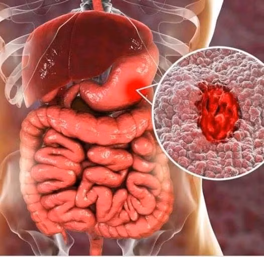 Biểu hiện ung thư dạ dày - Ảnh minh họa