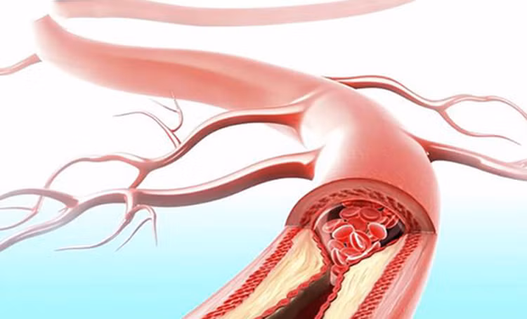 Mạch máu không sạch dẫn đến nhiều bệnh - ảnh minh họa