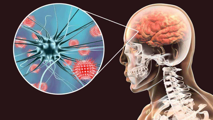 Các loại viêm màng não thường gặp - Ảnh minh họa