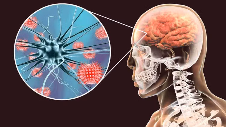 Các loại viêm màng não thường gặp - Ảnh minh họa