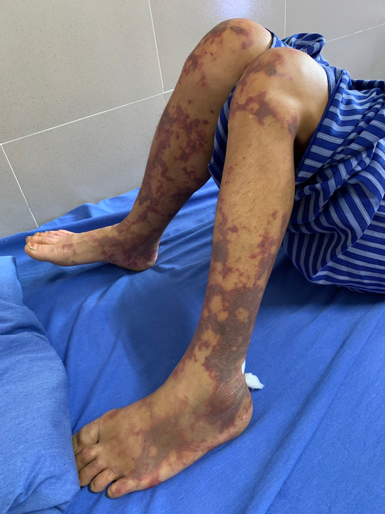 Hoại tử chi do nhiễm liên cầu khuẩn lợn