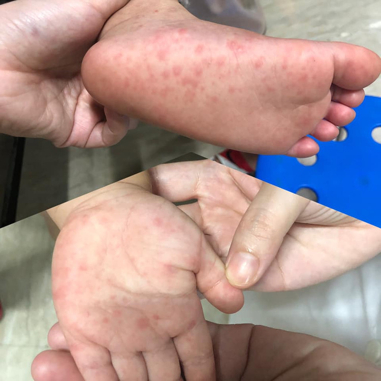 Bộ Y tế lập 7 đoàn kiểm tra, giám sát phòng chống bệnh tay chân miệng tại 14 tỉnh thành Bộ Y tế lập 7 đoàn kiểm tra, giám sát phòng chống bệnh tay chân miệng tại 14 tỉnh thành