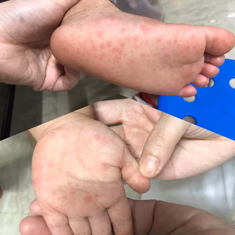 Bộ Y tế lập 7 đoàn kiểm tra, giám sát phòng chống bệnh tay chân miệng tại 14 tỉnh thành