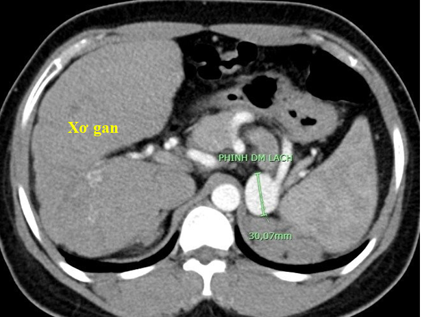 Hình ảnh xơ gan và phình động mạch lách trên phim chụp cắt lớp vi tính 128 dãy