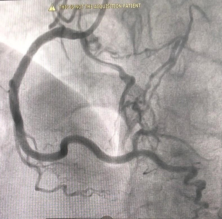 Hút thuốc lá, tăng huyết áp, người bệnh bị tắc 3 nhánh động mạch vành ảnh 5