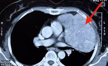 Mổ ruột thừa phát hiện u trung thất lớn đẩy xẹp phổi ảnh 1