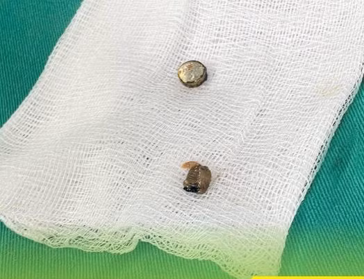 Dị vật được gắp ra từ âm đạo bệnh nhi 5 tuổi