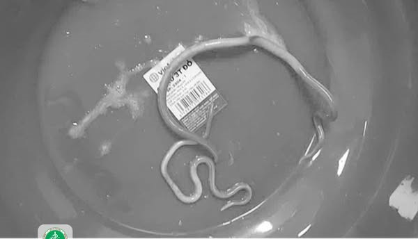 Bệnh nhân nôn cả ra giun -Ảnh BVCC