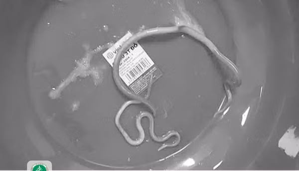 Bệnh nhân nôn cả ra giun -Ảnh BVCC