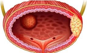 Bác sĩ chỉ rõ các yếu tố nguy cơ ung thư bàng quang - Ảnh Minh họa