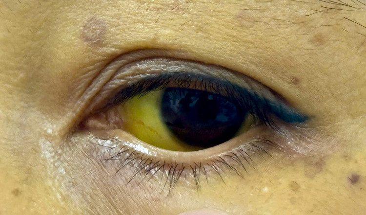 Vàng mắt tăng gấp hơn 20 lần - Ảnh BVCC