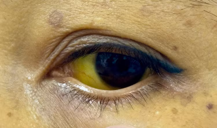 Vàng mắt tăng gấp hơn 20 lần - Ảnh BVCC