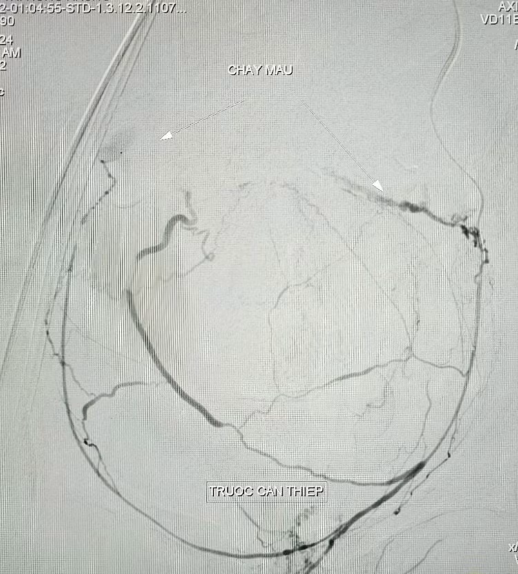 Cứu sản phụ bị băng huyết nguy kịch bằng kỹ thuật can thiệp nội mạch ảnh 3