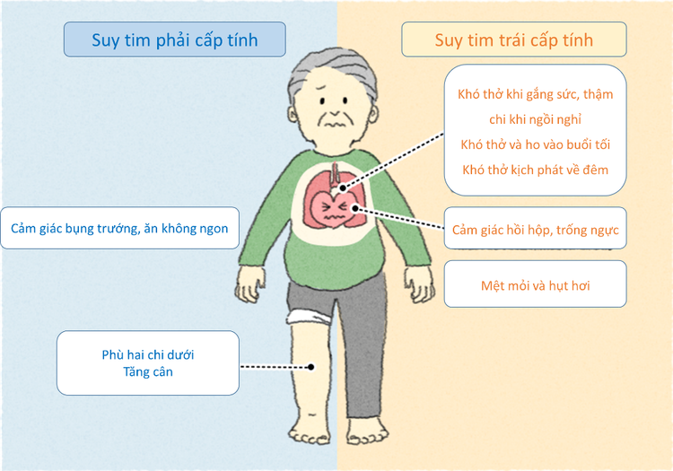 Các triệu chứng, dấu hiệu của suy tim cấp - Ảnh BSCC