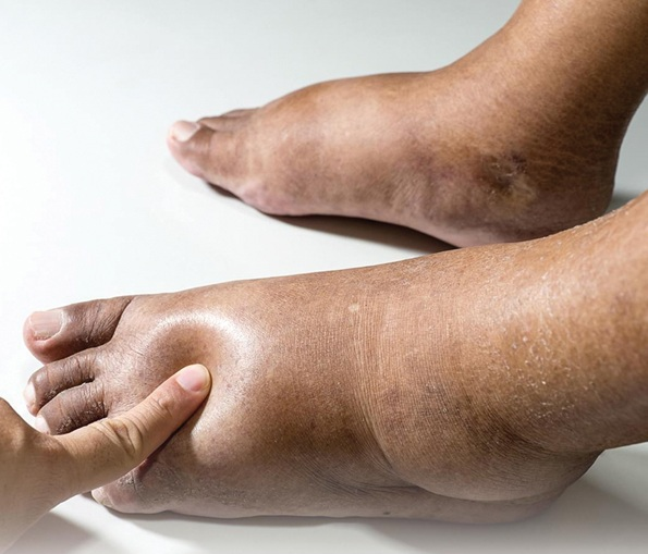 Cách kiểm tra phù chân tại nhà: ấn vào vùng mu chân hoặc mắt cá chân thấy vùng da tương ứng lõm xuống - Ảnh BSCC