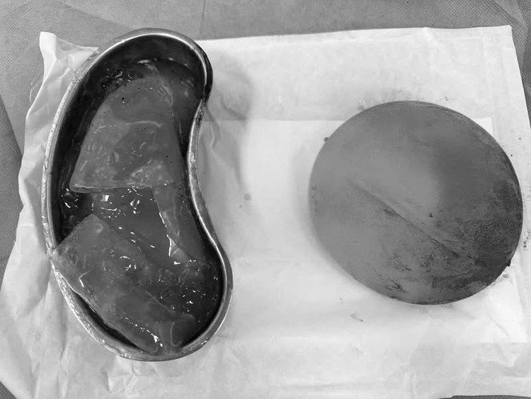 BS Nghĩa cùng ê-kíp phẫu thuật tháo bỏ túi vỡ, bóc toàn bộ bao xơ và thay túi ngực mới cho người phụ nữ. (Ảnh: BSCC)