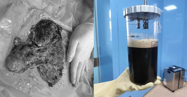 Khối u nang lớn chứa nhiều dịch được phẫu thuật nội soi cắt bỏ thành công - Ảnh BVCC