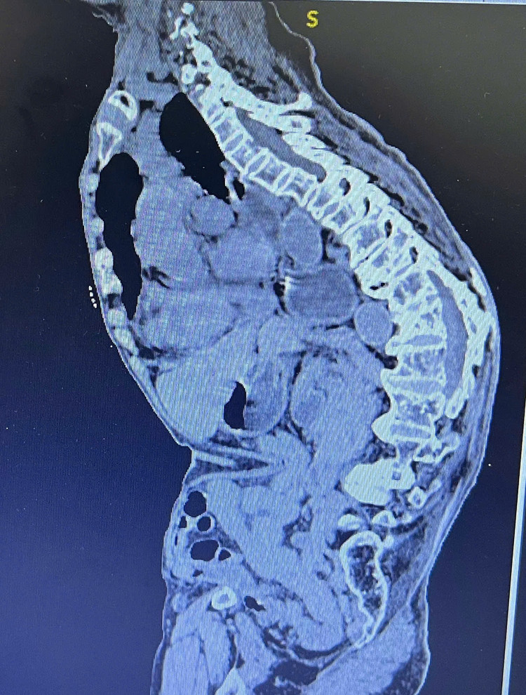 Hình ảnh phim chụp bệnh nhân bị gù vẹo cột sống nặng - Ảnh BSCC